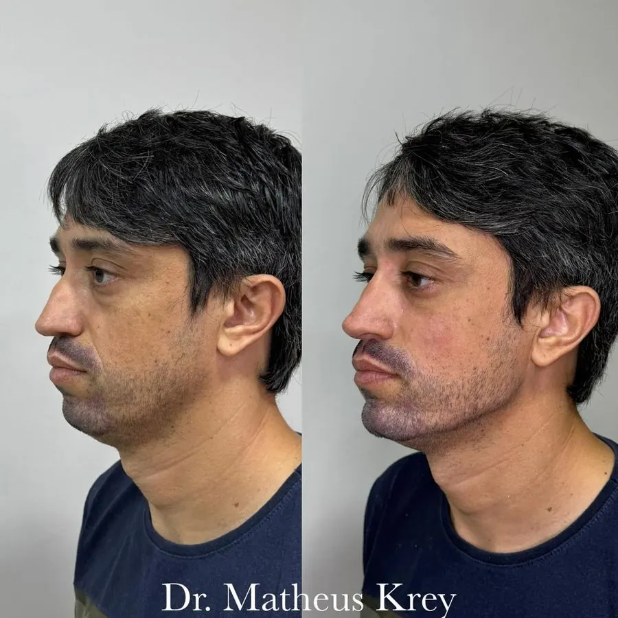 Antes e depois: contorno mandibular