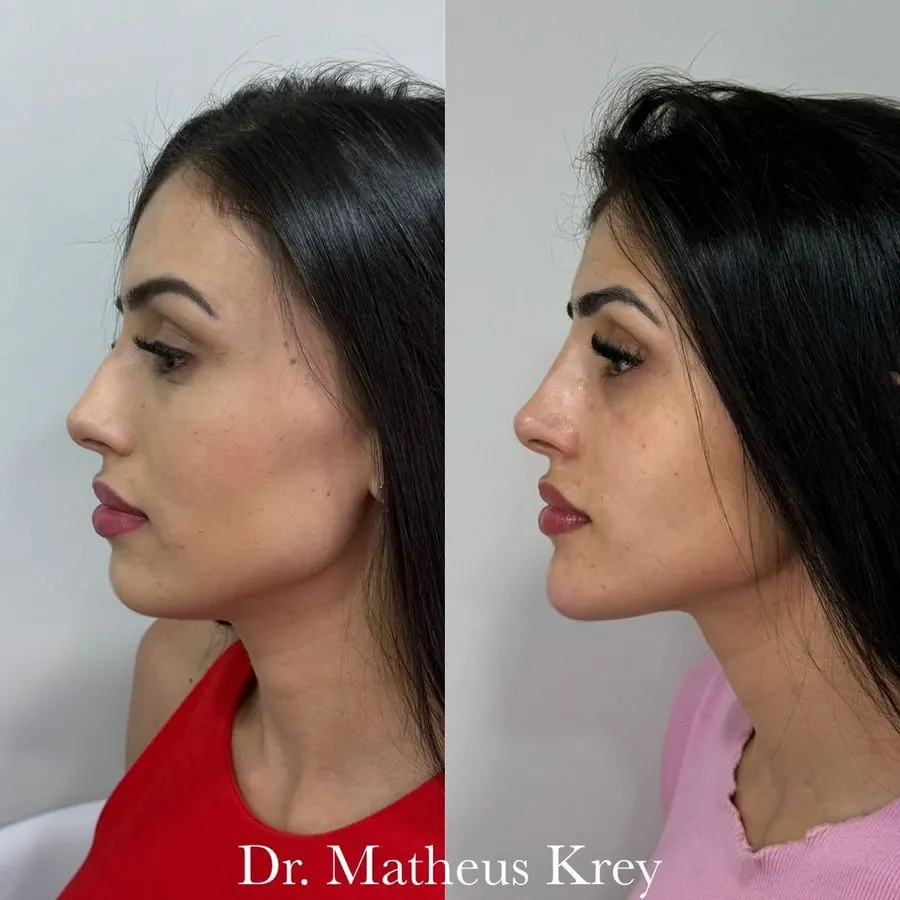 Antes e depois: harmonização de perfil