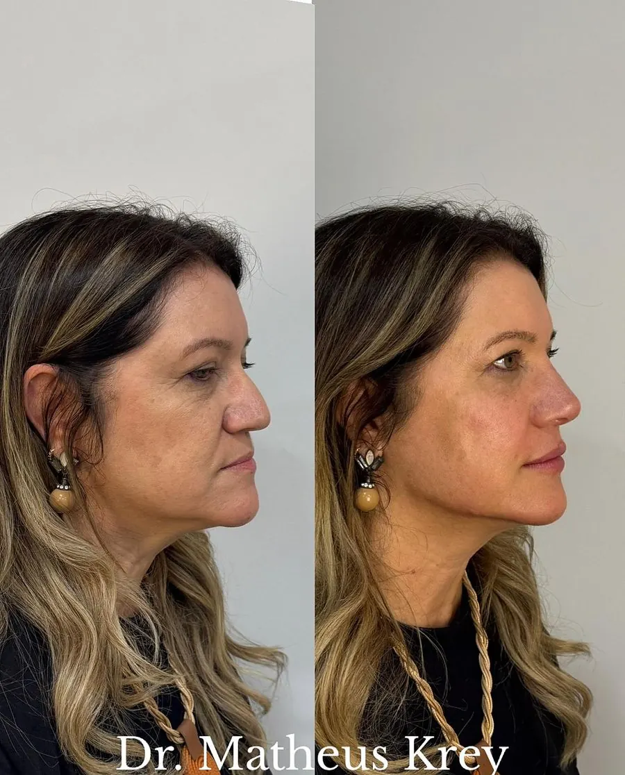 Antes e depois: rejuvenescimento facial