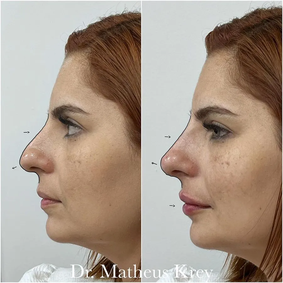 Antes e depois: rinomodelação e lábios